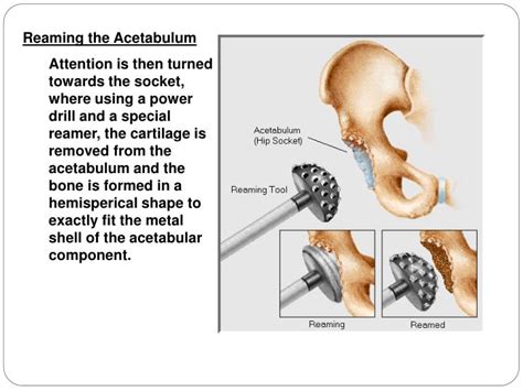 acetabular reaming technique|ACETABULAR REAMING ACCURACY: OPTIMAL .